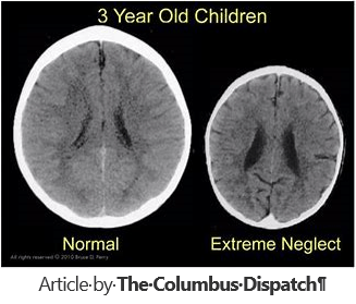 Image result for brain scans of complex trauma